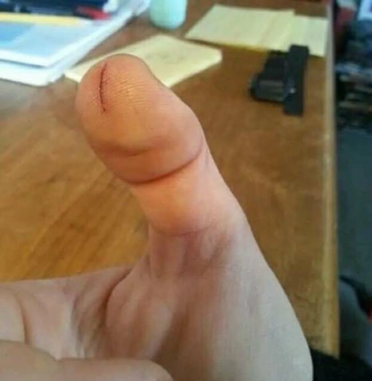 A close-up photo shows a person's thumb with a small, stitched wound on the fingertip, held up against a wooden desk…
