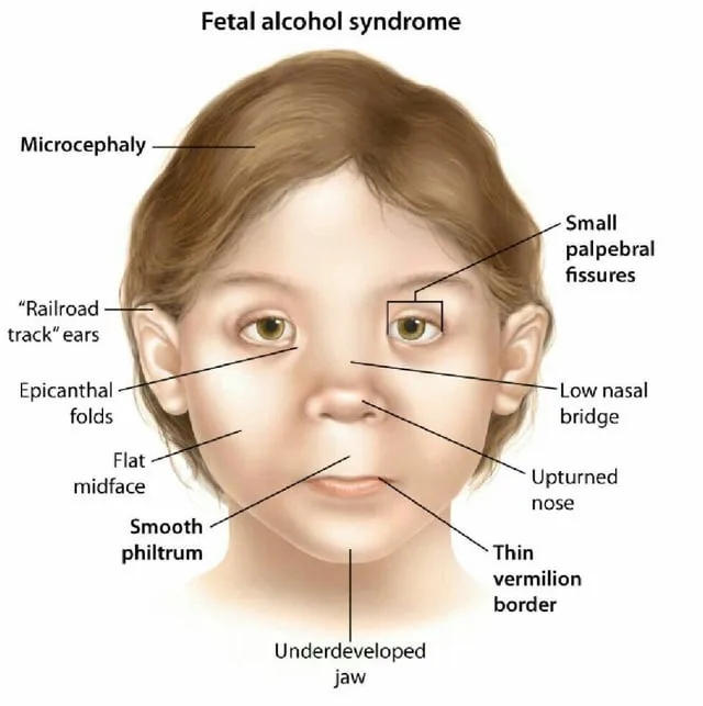 An anatomical diagram of a child's face labeled with medical terms like 'Microcephaly', 'Small palpebral fissures', 'Flat…
