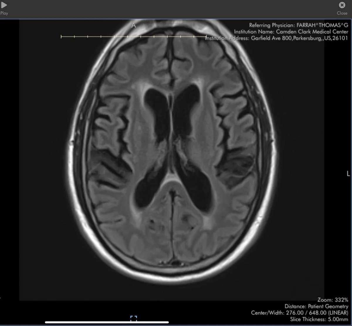 A grayscale medical MRI scan of a human brain, showing detailed anatomical structures. Overlaid text in the top right corner…