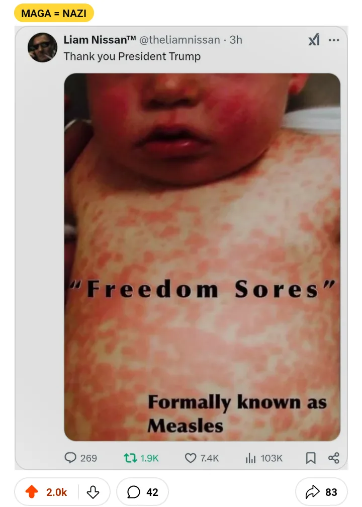 A screenshot of a tweet by Liam Nissan™ showing a close-up photo of a baby with widespread red spots on its face and chest…