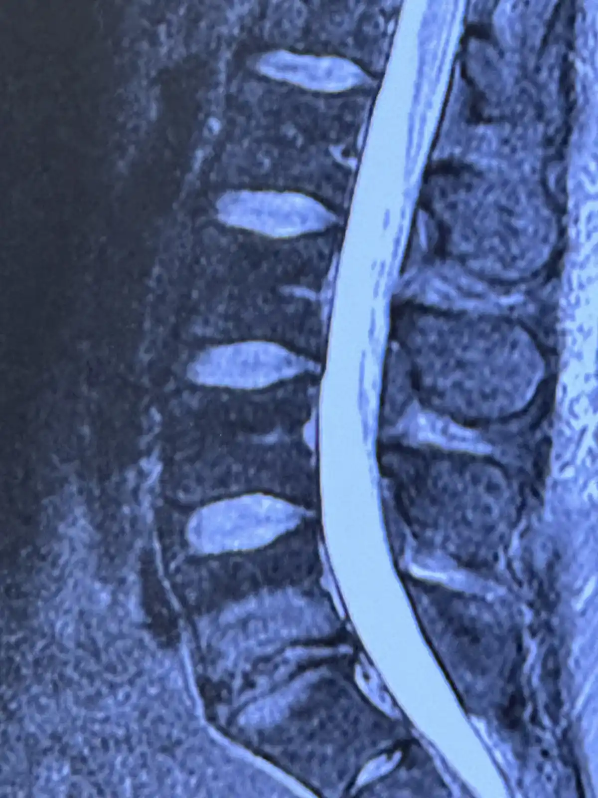 A medical scan image shows a human spine with vertebrae and spinal canal, overlaid with the text 'i'm not a spine, i'm a…