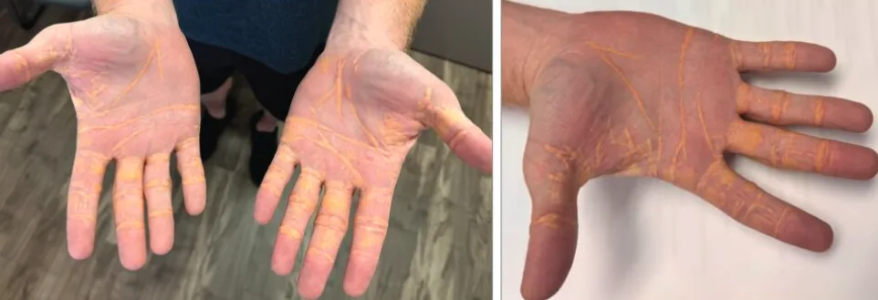 The image shows two side-by-side photos of a person's hands covered in orange-colored residue, resembling dried paint or…