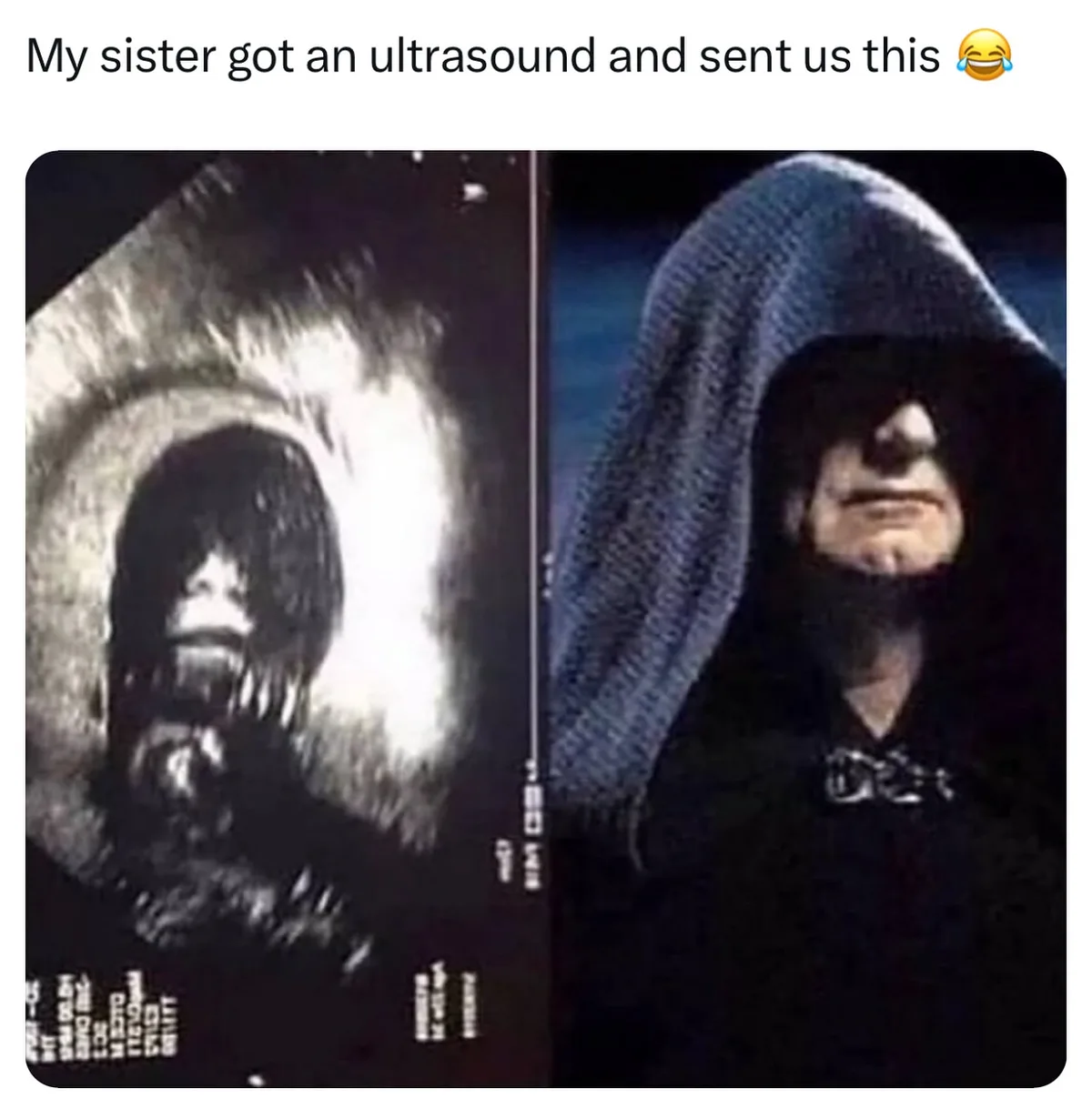 The image displays a side-by-side comparison: on the left, a grayscale ultrasound image of a fetus that resembles a…