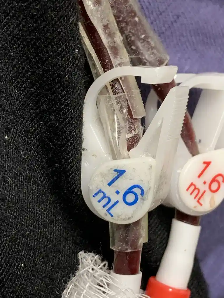 Enhancing Catheter Performance with Extra Tubing to Prevent Crimping