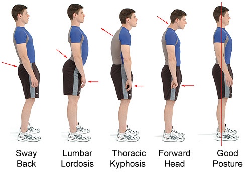 A sequence of five side-profile images of a man in athletic wear showing progressively worsening posture issues, labeled…