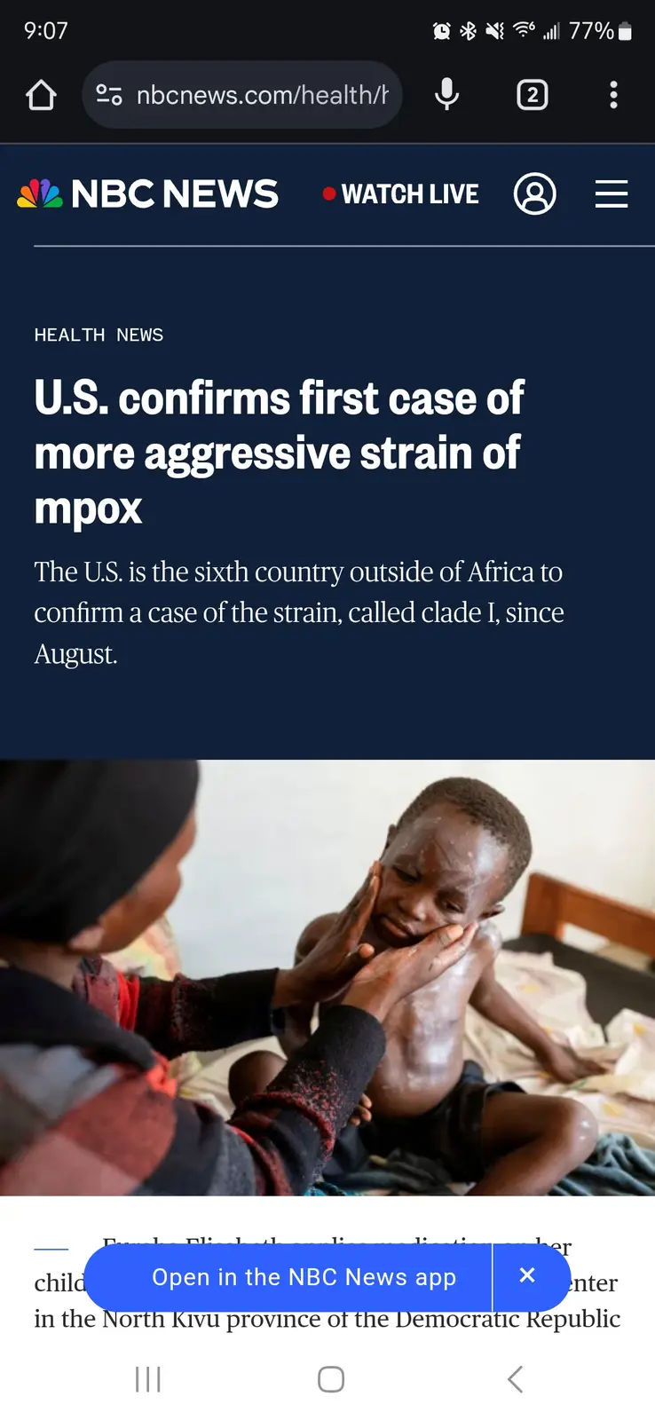 A screenshot of an NBC News article about a U.S. mpox case, overlaid with a photo of a child with visible skin lesions being…