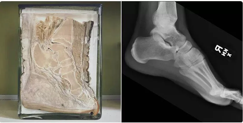 The image is a side-by-side comparison: on the left, a preserved human foot specimen in a glass case, and on the right, an…
