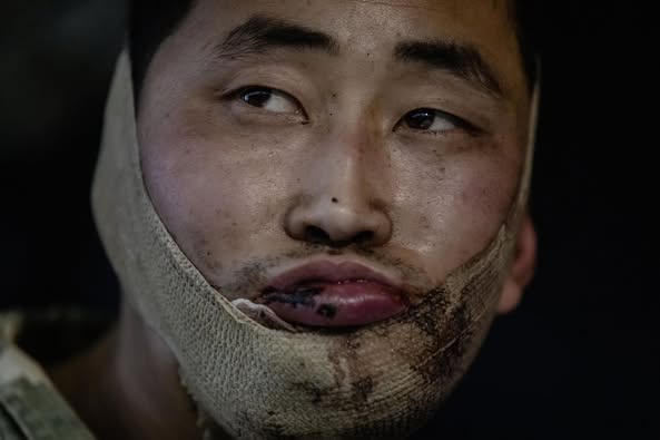 A close-up of a man with a bandage wrapped around his lower face and chin, his mouth slightly open and eyes looking upward…