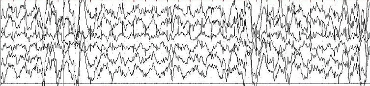 The image shows a black-and-white line graph with jagged, chaotic, and highly erratic lines resembling an electrocardiogram…