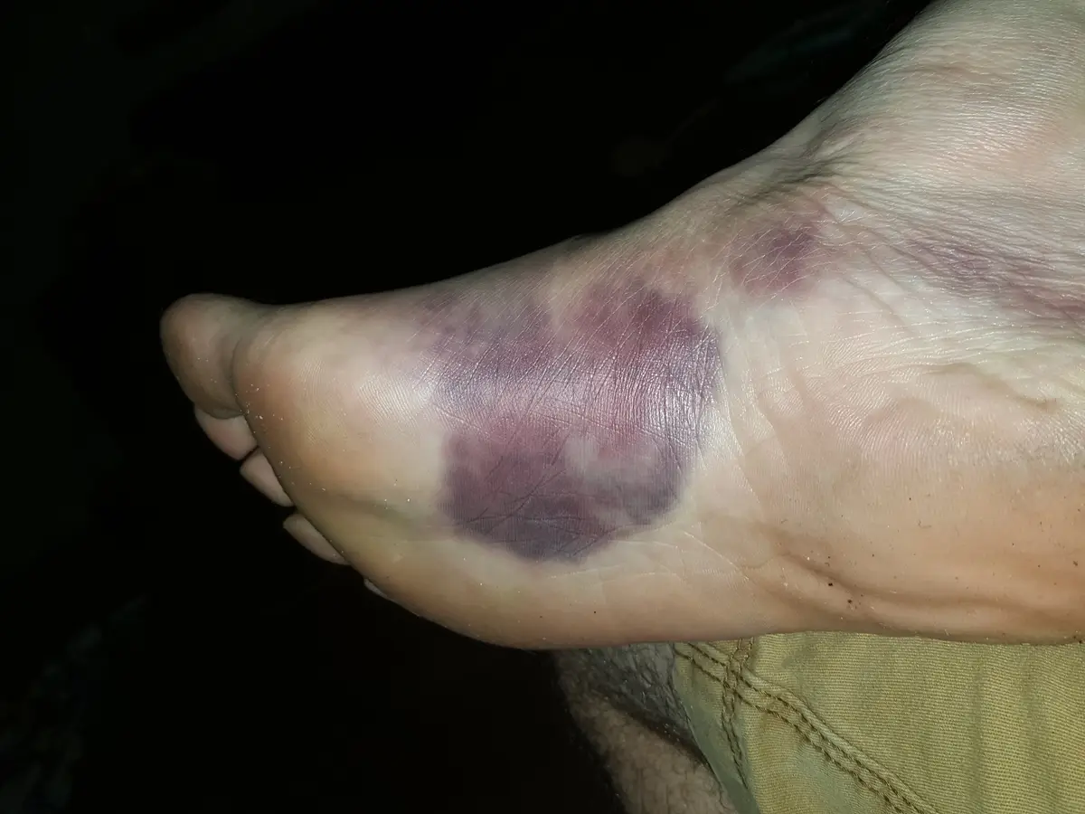 A close-up photo shows the underside of a person's foot with a large, purplish bruise covering the arch area. The foot is…