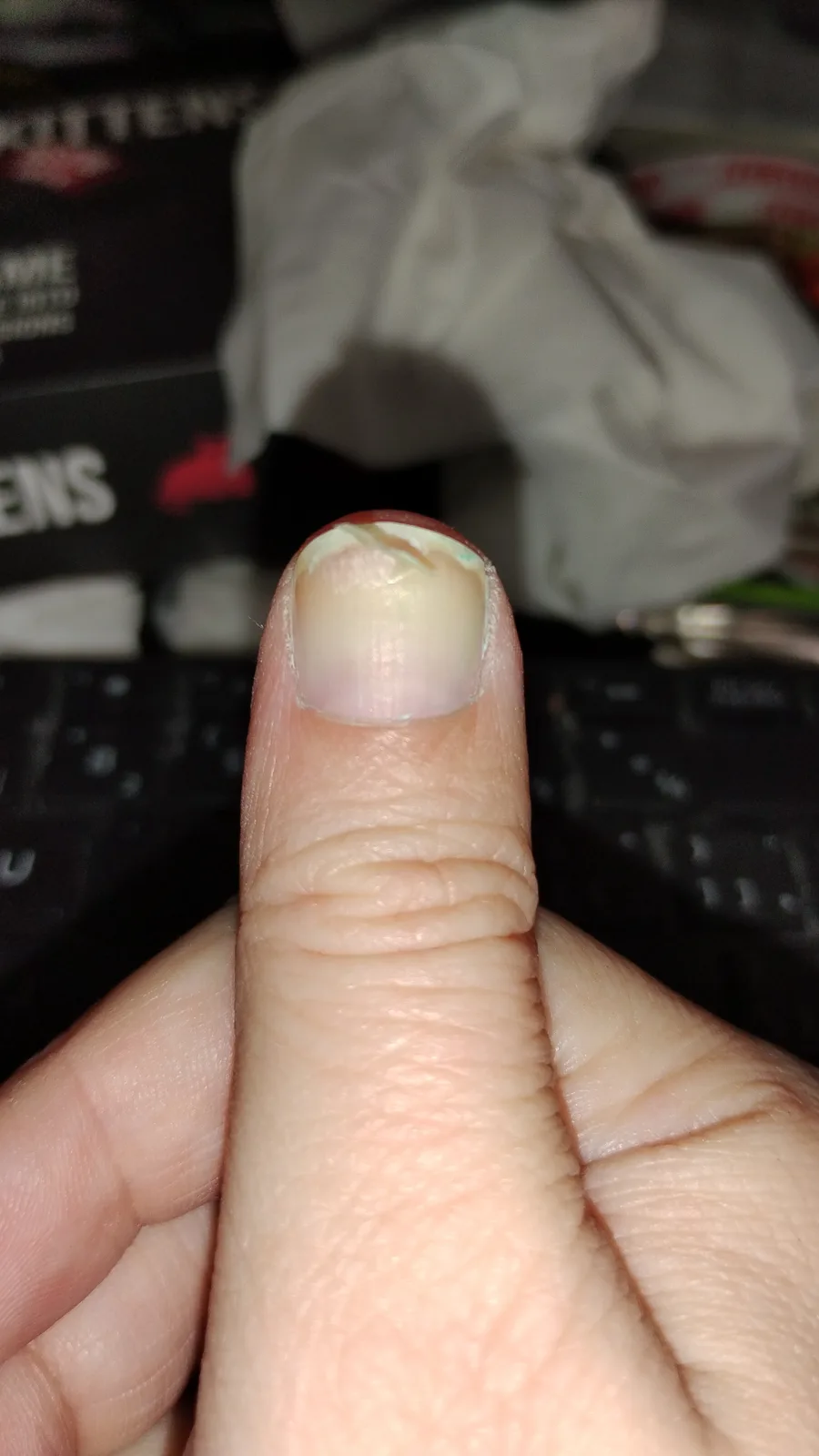 A close-up photo shows a person's thumb with chipped and peeling light green nail polish on the fingernail, held up against…