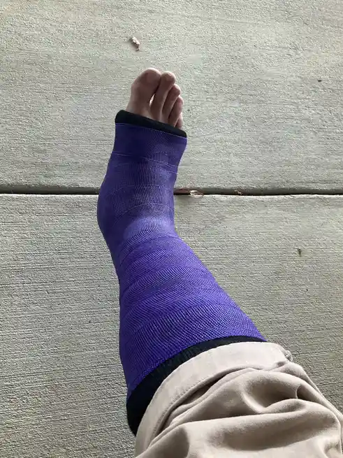A person's foot and lower ankle are wrapped in a purple, textured medical cast or boot, resting on a light gray concrete…