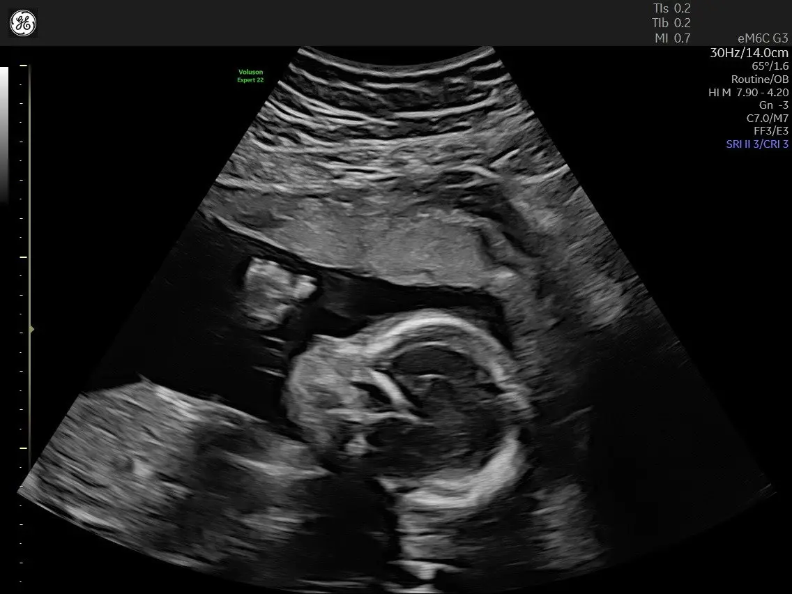 A grayscale ultrasound image shows a developing fetus curled inside the womb, with medical equipment text visible in the…