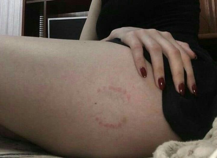 A close-up photo shows a person's thigh with a faint, circular red mark resembling a tattoo outline, while their hand with…