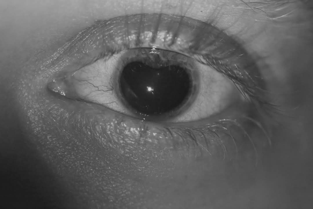 Understanding Iritis: What You Need to Know