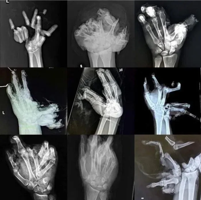A collage of nine x-ray images showing various severely broken, shattered, and dislocated hands and wrists, with the…