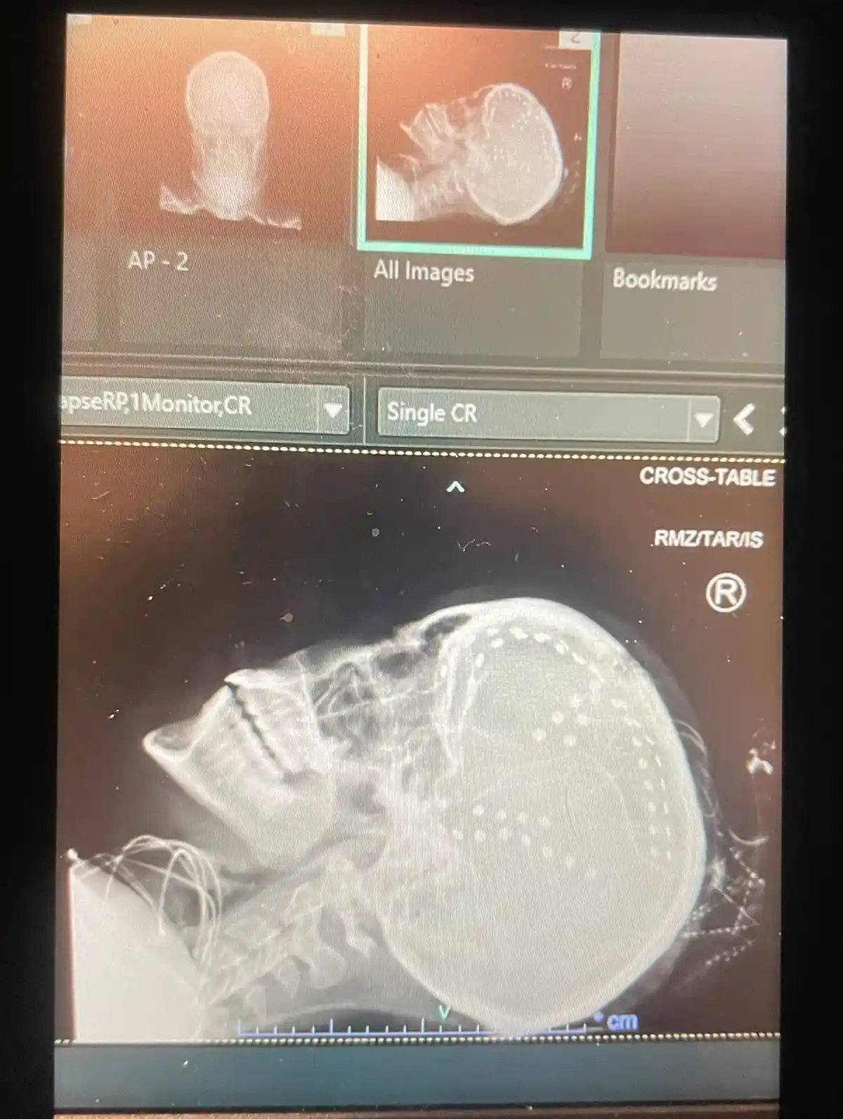 A medical imaging screen displays a cross-table X-ray of a baby's skull, showing the infant's head and neck in profile. The…