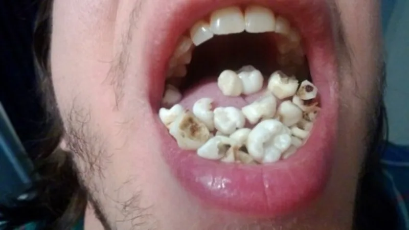 A close-up shot of a person's open mouth showing numerous extracted teeth scattered on their tongue and gums. The teeth…