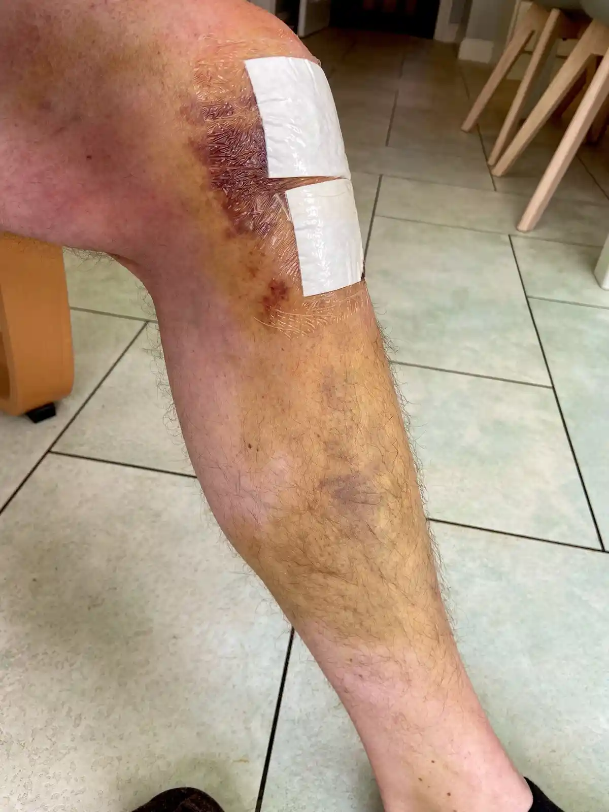 A close-up photo shows a person's injured leg with a large, raw, and reddish wound near the knee, partially covered by two…